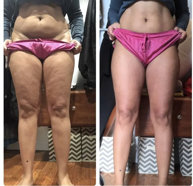 Cellulite Treatment